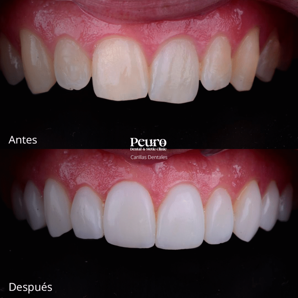 Carillas Dentales 1