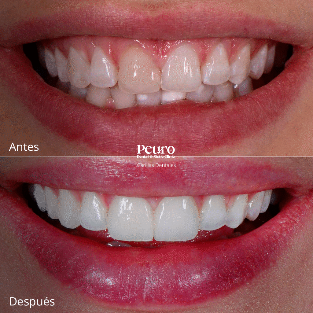 Carillas Dentales 2
