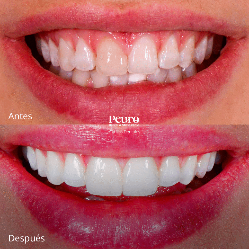 Carillas Dentales 2